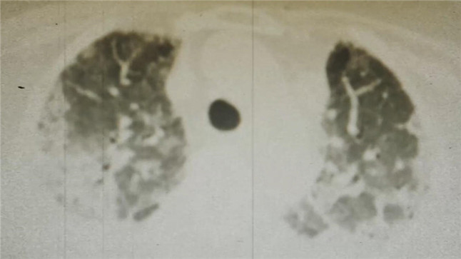 同筑健康防线丨流感超过一周还有传染性吗 同筑健康防线丨流感超过一周还有传染性吗